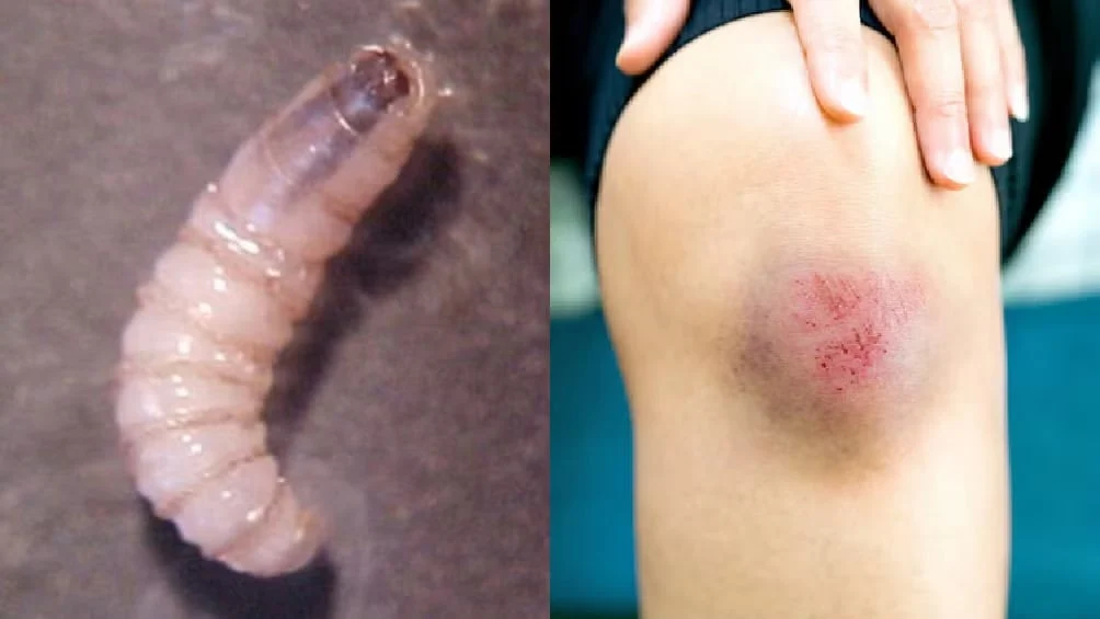 Suman 16 casos de gusano barrenador en humanos en Oaxaca