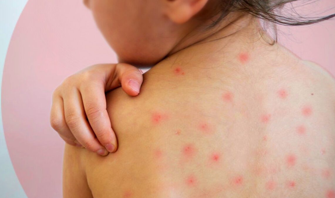 Reportan 151 contagios de sarampión en últimas 48 horas; van más de 14 mil casos en México