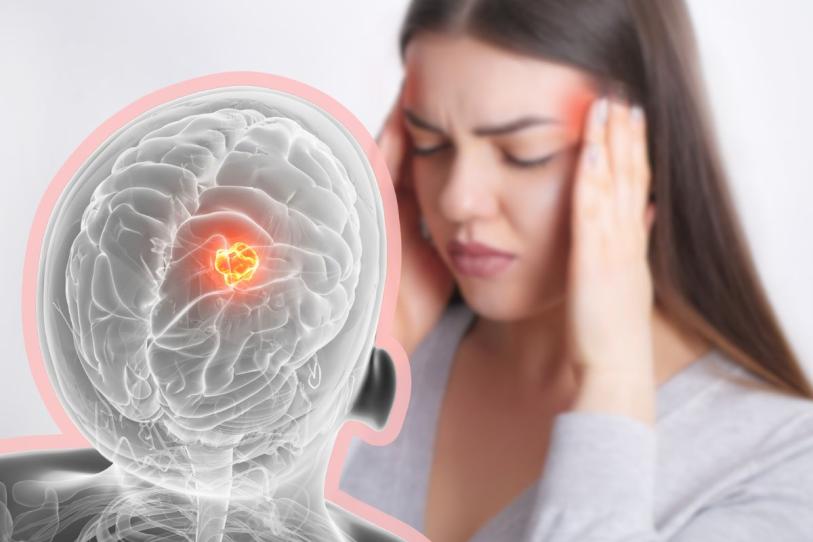 ¿Cuándo el dolor de cabeza puede ser síntoma de tumor cerebral?