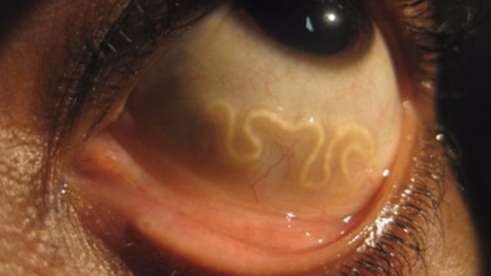 El gusano que cruza tu ojo: qué es y cómo se mueve por el cuerpo humano