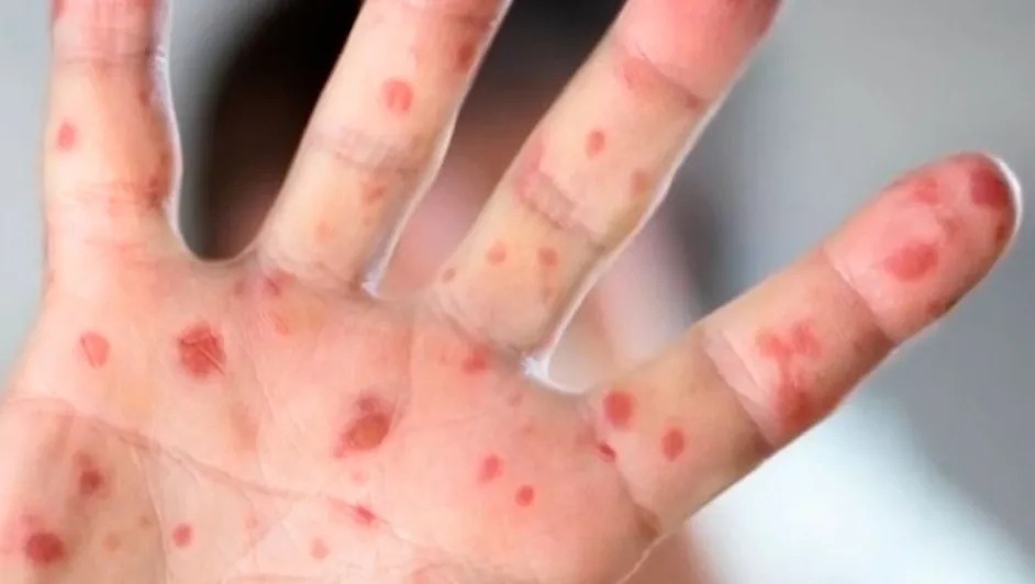 Casos de sarampión aumentan a 19 mil 134 en México