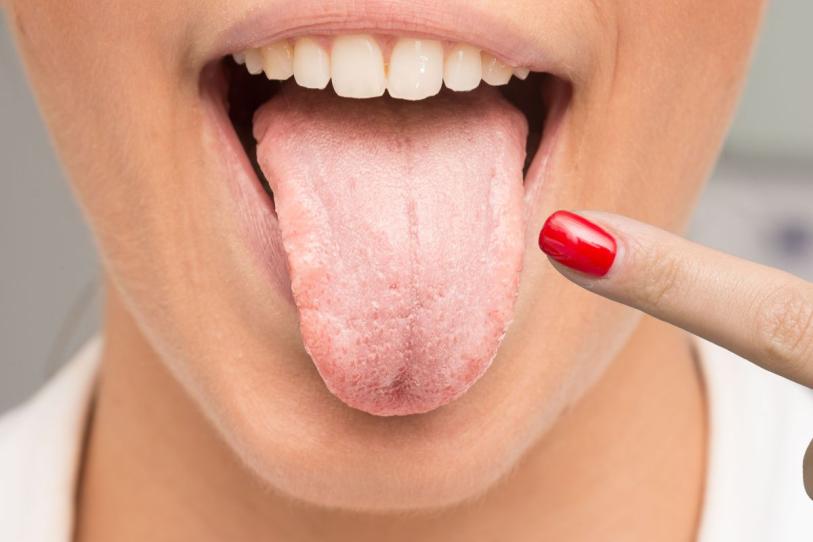 Algodoncillo o candidiasis bucal: ¿qué hacer ante las manchas blancas?