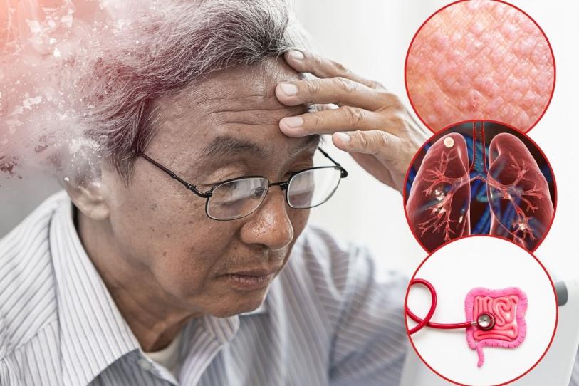 Alzheimer: inflamación en piel, pulmones e intestino podría estar relacionada