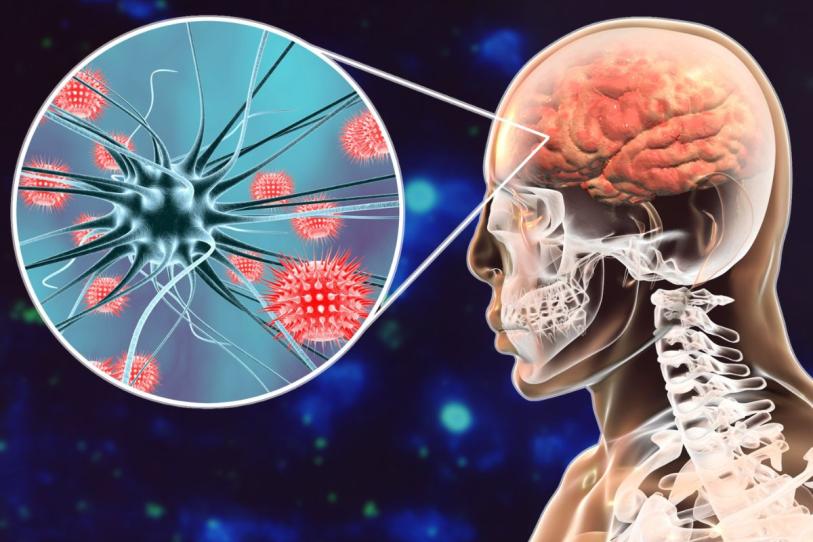 ¿Qué pasa después de sobrevivir a la meningitis? Estas secuelas podrían permanecer